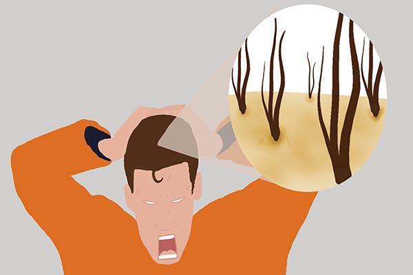 抓头发指甲里面有白泥,头发用指甲抠一下有很多白泥