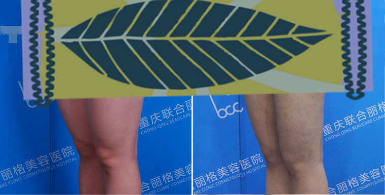 女性腰腹吸脂手术全过程,肥胖的人可以吸脂减肥吗