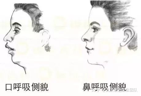 武汉牙齿反颌矫正最佳方案,牙齿矫正可以改善口呼吸面容吗