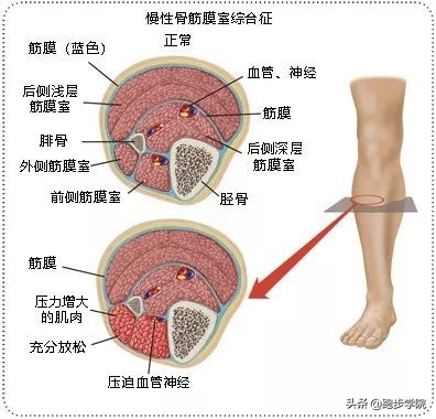 伤害了1/3跑者的胫骨炎,请务必重视起来