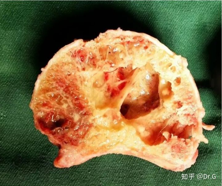 短时间用激素一定会股骨头坏死吗,没服过激素会股骨头坏死吗