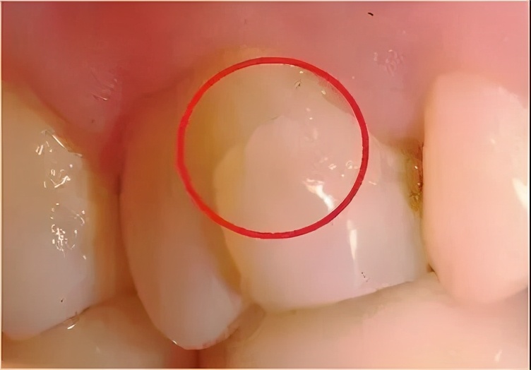 喝凉水牙齿瞬间会特别痛,喝凉水牙齿痛是烂到神经了吗