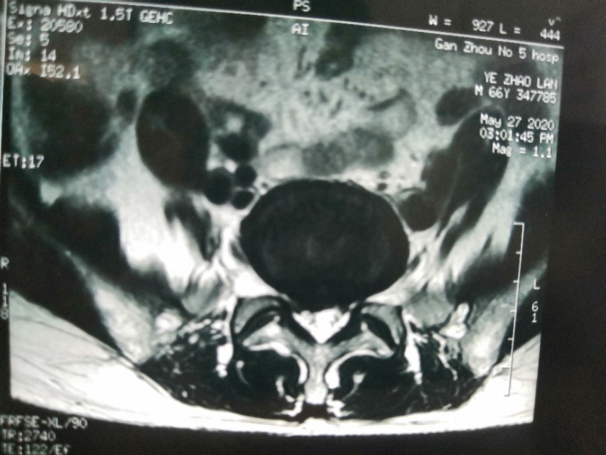 腰椎微创手术危险吗,腰椎微创手术有风险吗