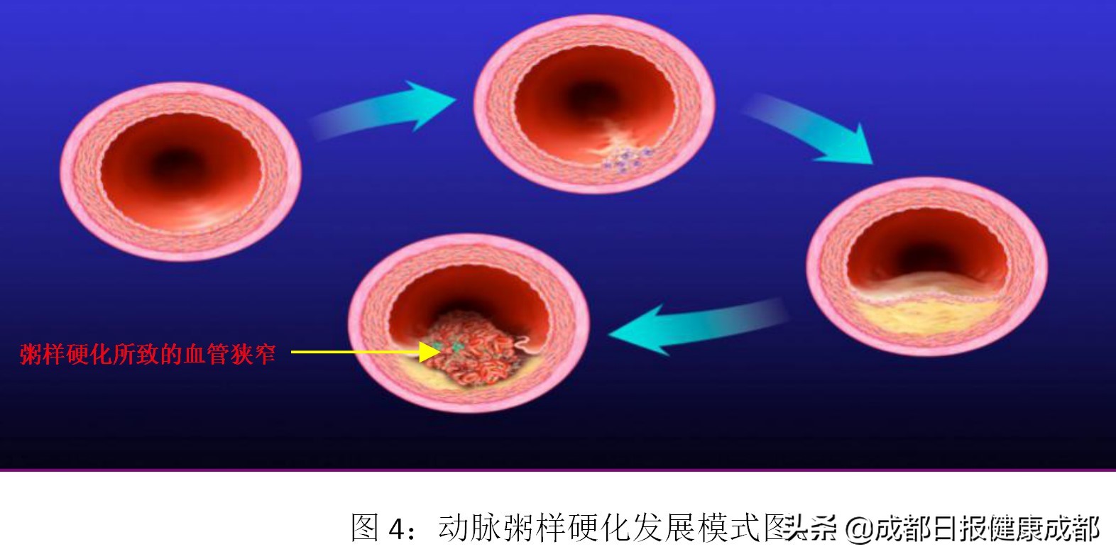如何控制脑血管中风,脑血管堵了三根做搭桥还是支架