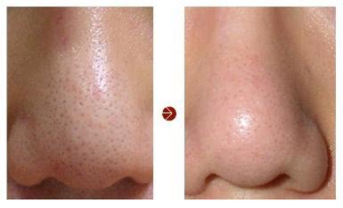 微针美容是否适合你一份详细指南,毛孔粗痘坑用什么微针精华