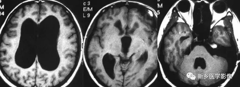 影像学脑室扩大,脑室显大怎么理解