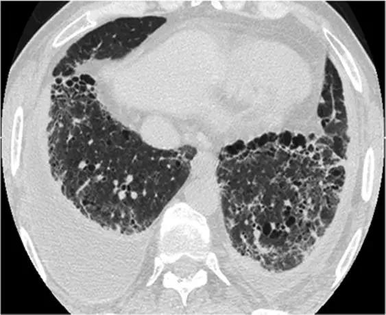 间质性肺疾病看病经验分享,分享肺腺癌临床实验的例子