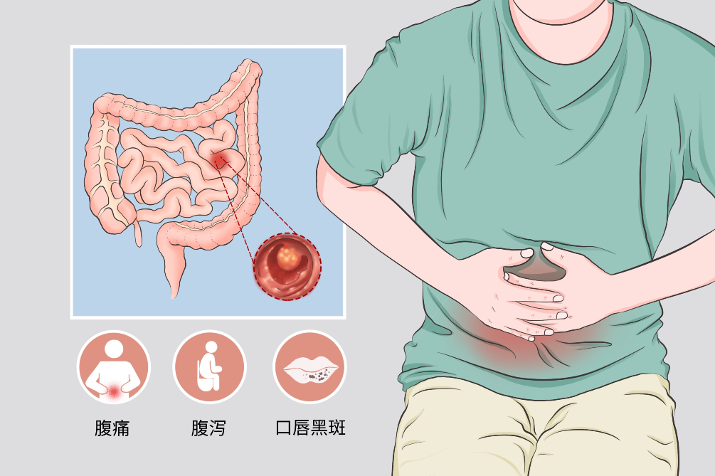 黑斑息肉综合征有什么症状,黑斑息肉综合征临床表现