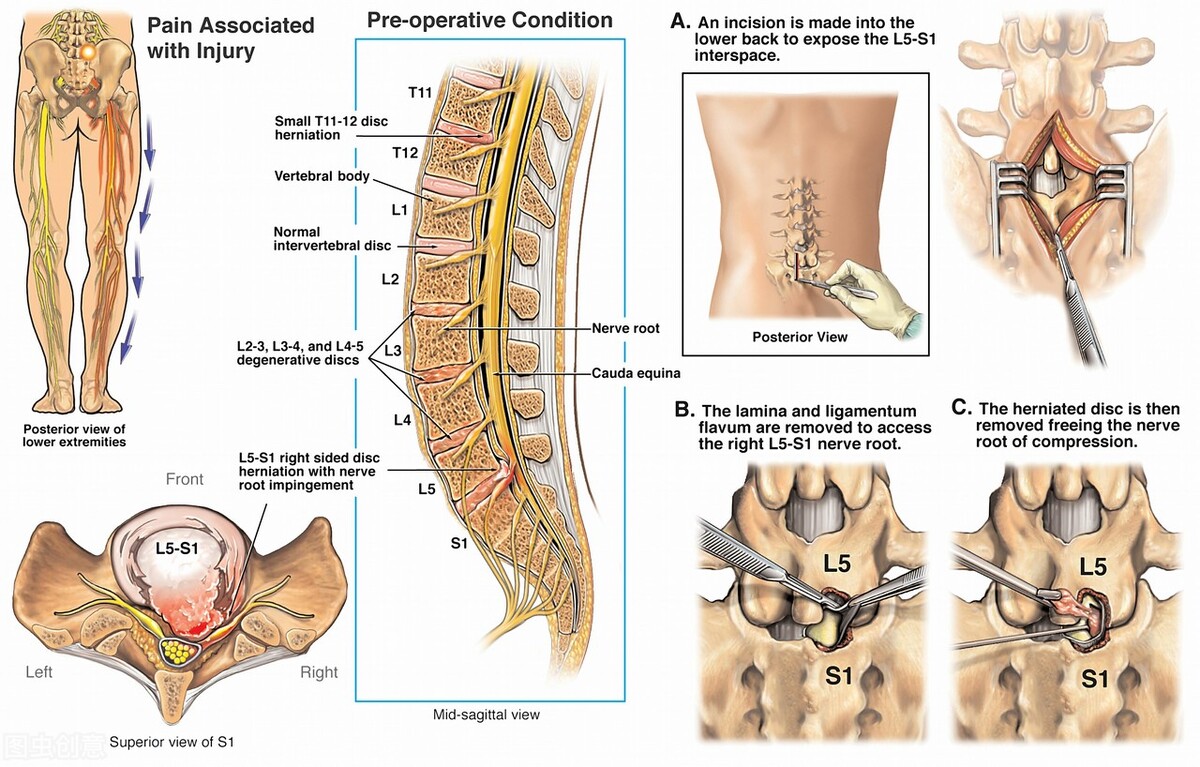 糖尿病周围神经病变的中医分型,糖尿病足神经病变治疗视频