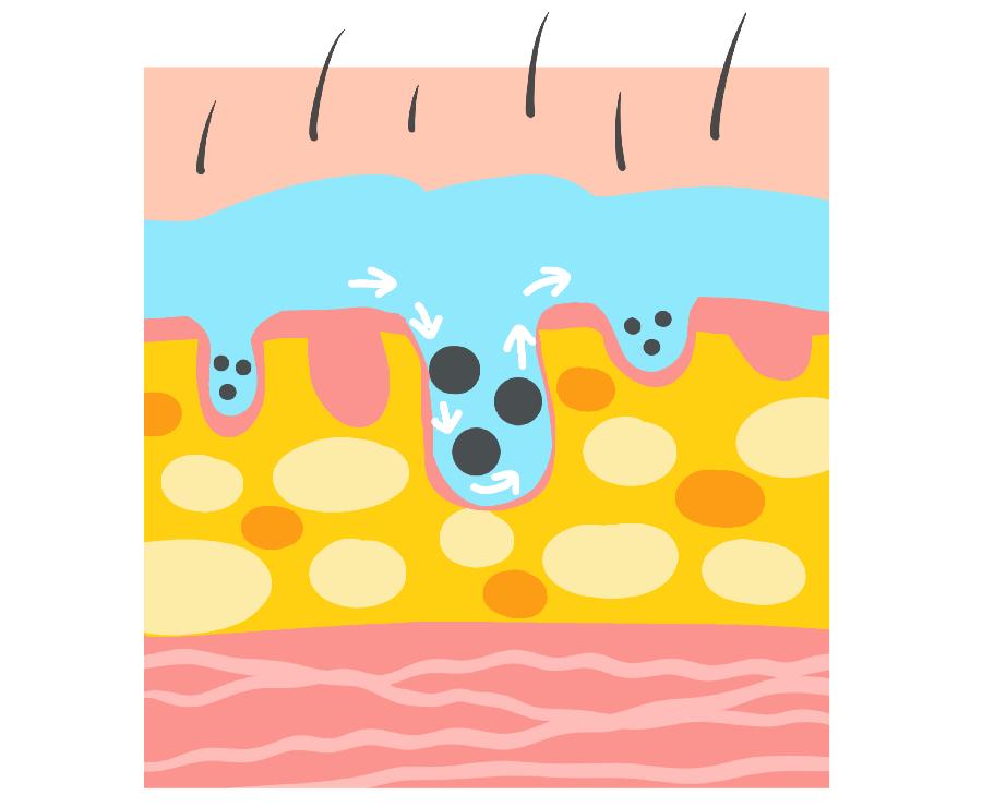 冻疮反复怎么治才可以除根,冻疮反复发作怎么根除