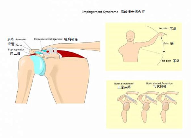 胳膊与肩膀相连处疼痛是什么原因,肩膀像挑担子一样疼痛是什么原因