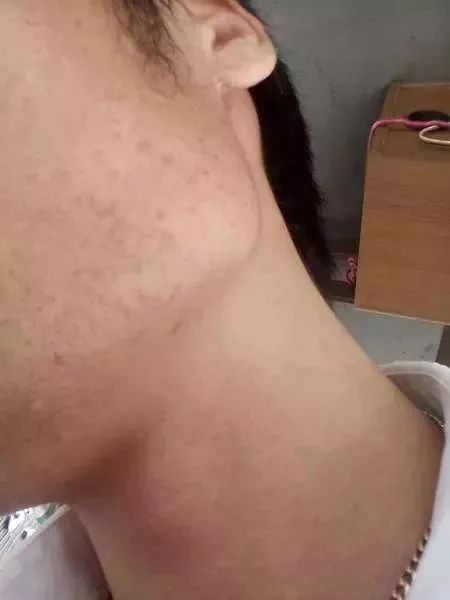 鼻子长痘是肝火还是胃火,鼻子长斑是情绪问题吗