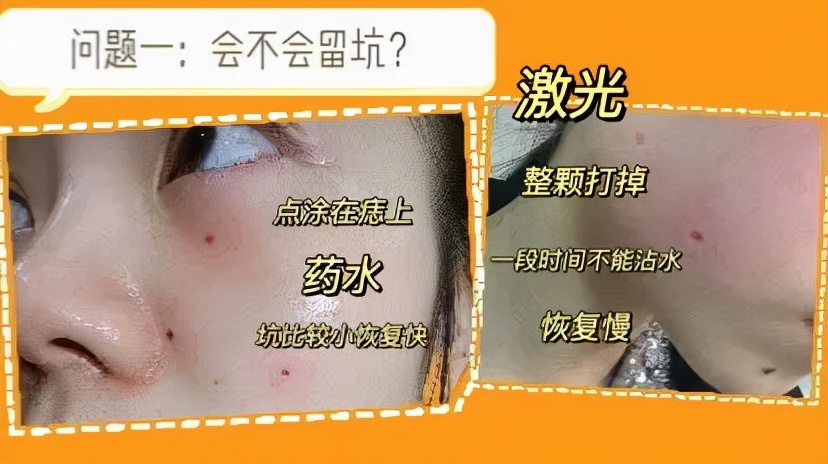 药水点痣一星期了还忌口吗,药水点痣后续护理