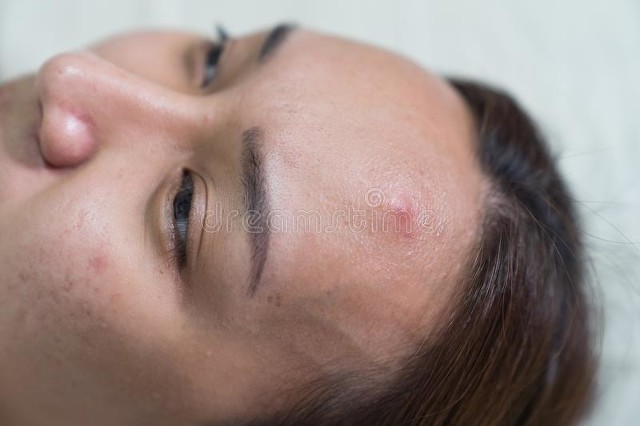 白色有脓的痘痘怎么处理,火疖子白色脓头能挤吗