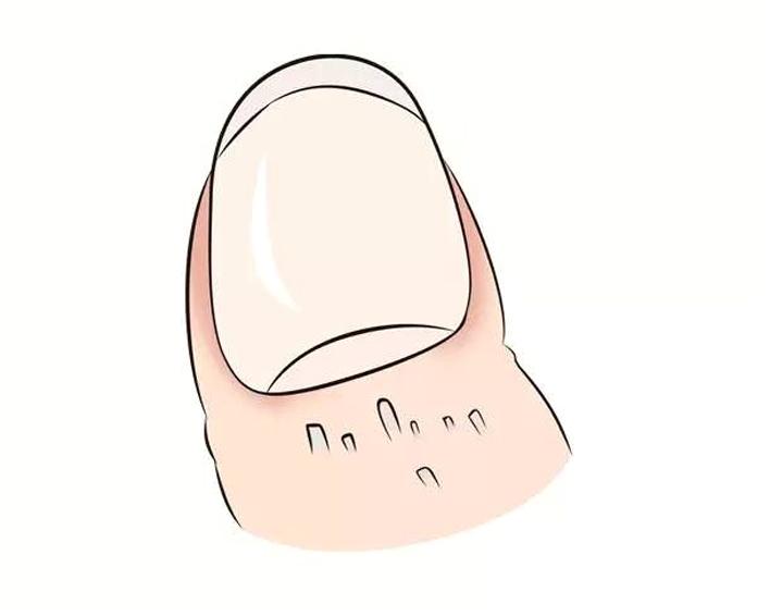 手指甲起倒刺缺维生素什么,手指甲倒刺缺维生素