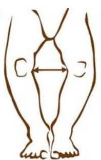 o型腿矫正,o型腿正骨