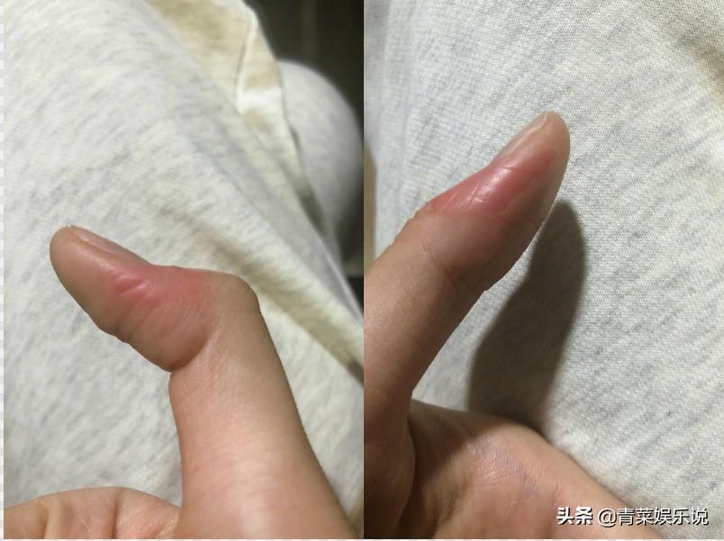 张馨予拍戏遭遇“低温烫伤”,张馨予晒受伤照片