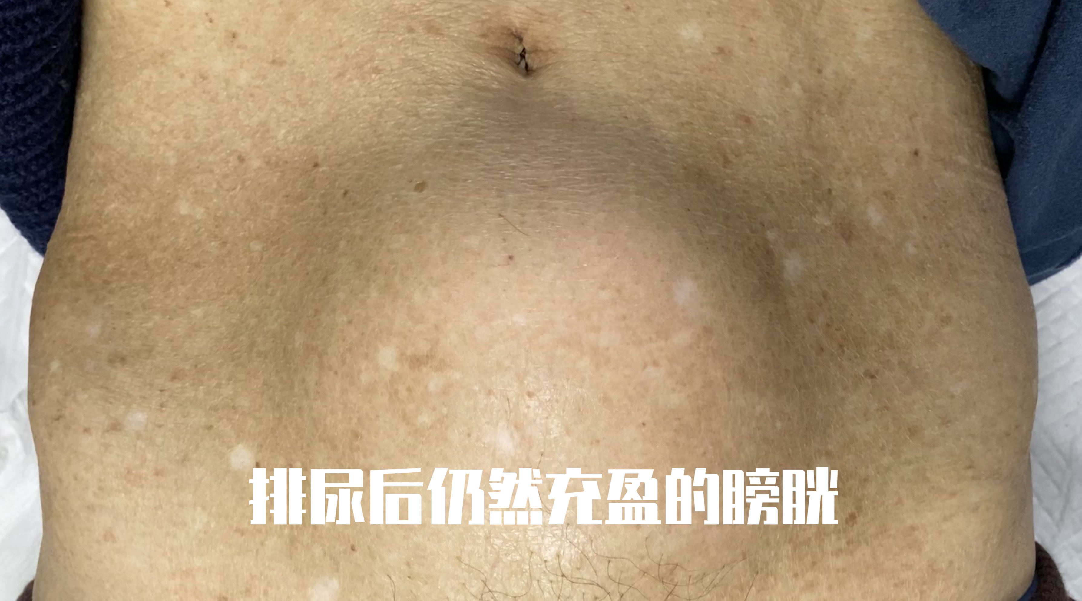 前列腺增生究竟治还是不治？不要着急说不！先了解下这些危险因素