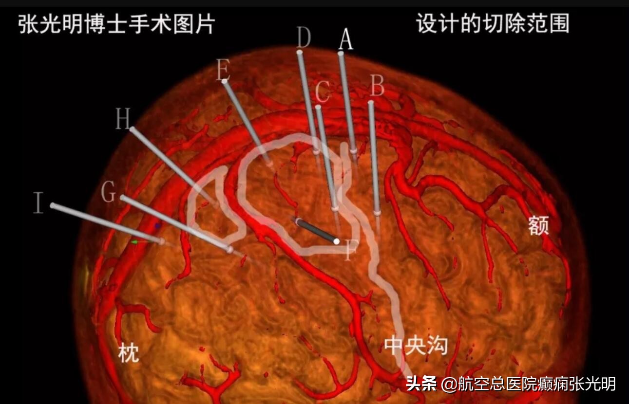 额叶癫痫灶手术定位评估,癫痫病灶定位最准确方法