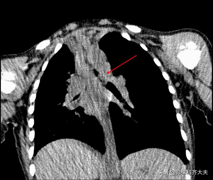 孩子支气管异物ct能查出吗,儿童支气管异物诊断方法