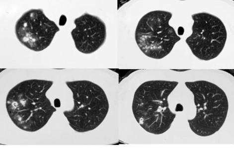这种病菌1亿年前就有了，后来地球出现人类，它又学会了感染人肺