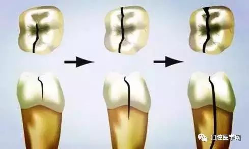 牙洞牙痛怎么快速止痛,下大牙痛有牙洞怎么办