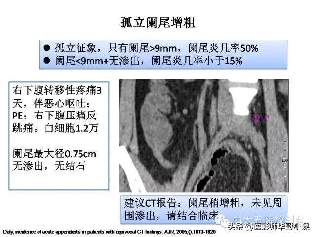 阑尾炎课件,阑尾炎的超声课件