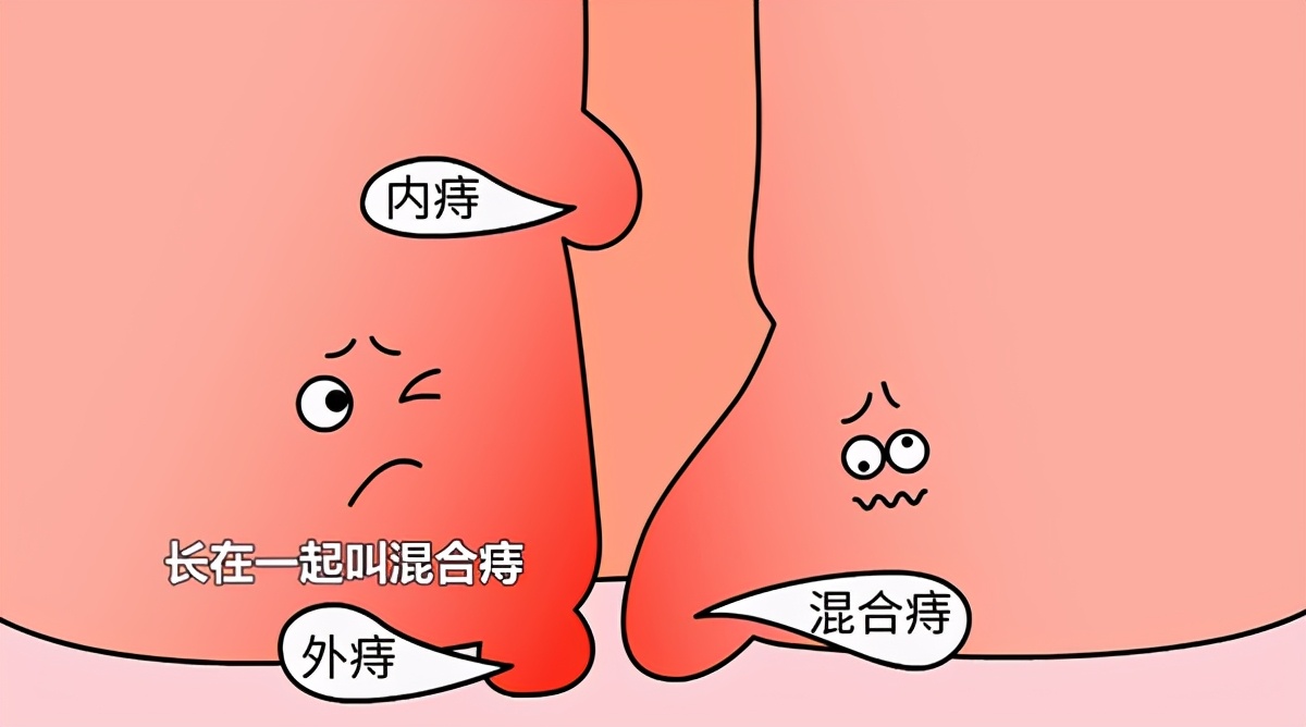 有内痔外痔同时存在的吗,有内痔混合痔
