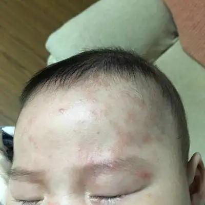 宝宝湿疹反反复复预防护理有技巧,宝宝湿疹的正确防治方法