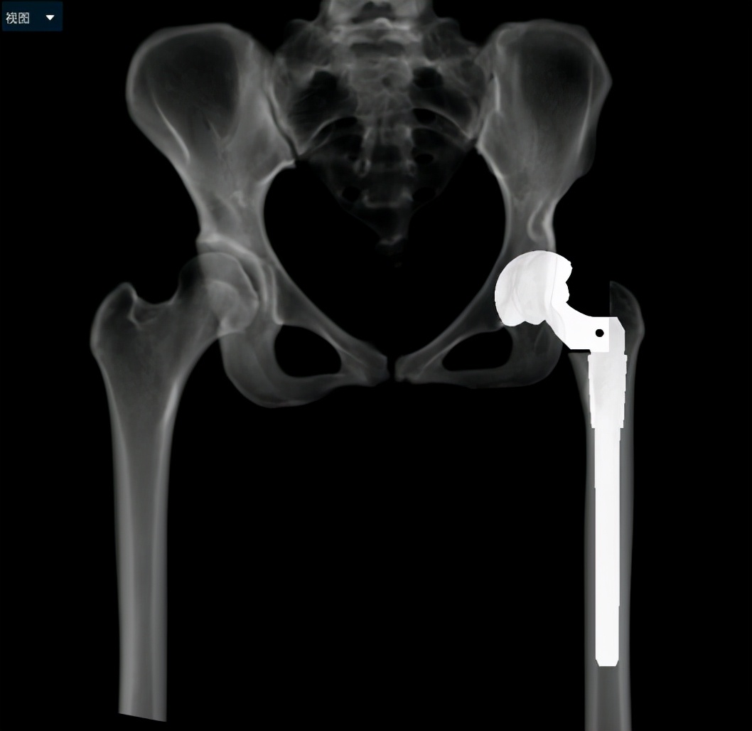 AI助力精准处理IV型髋关节发育不良花季少女翻开人生新篇章