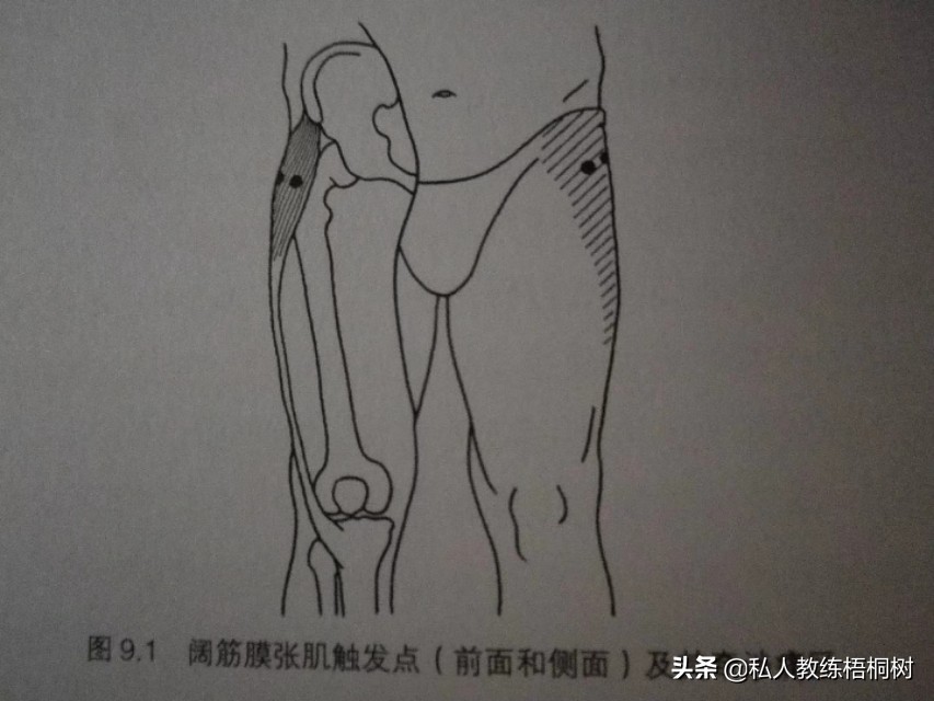 肌肉起止点,肌肉起止点松解