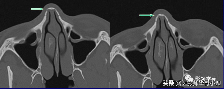 「鼻骨彩图」鼻骨CT解剖及骨折影像学诊断