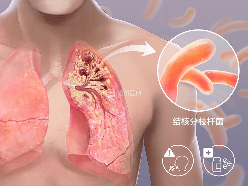 怀孕三个月后老公确诊肺结核,怀孕3个月我老公查出肺结核