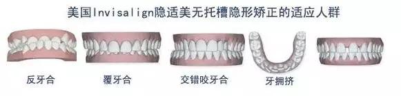 隐型矫正器和固定矫正器的区别,天使隐形矫正与隐适美矫正的区别