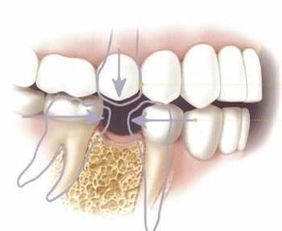 后槽牙缺失不想种植还有什么方法,牙齿缺失的修复方式有哪些
