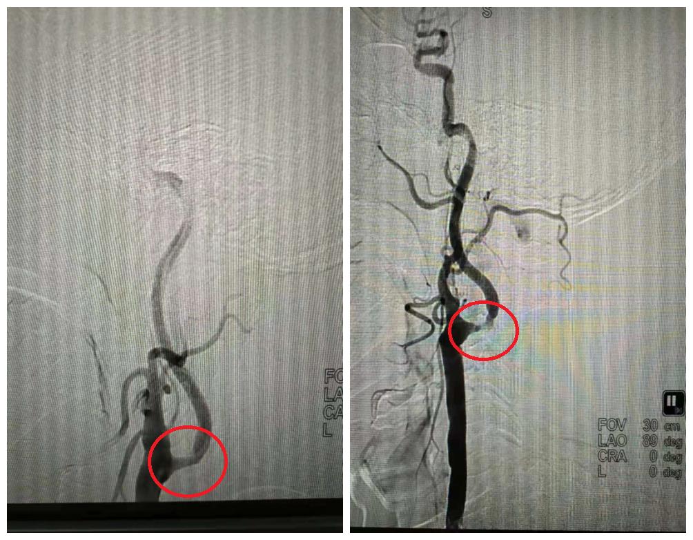 75岁老人多发性脑梗死,DSA介入治疗打通大脑“生命线”