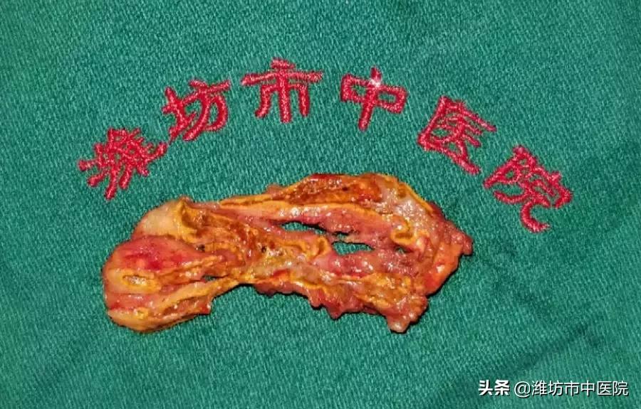 肺癌晚期肝转移肾转移能活多久,肺癌晚期肾转移有哪些表现