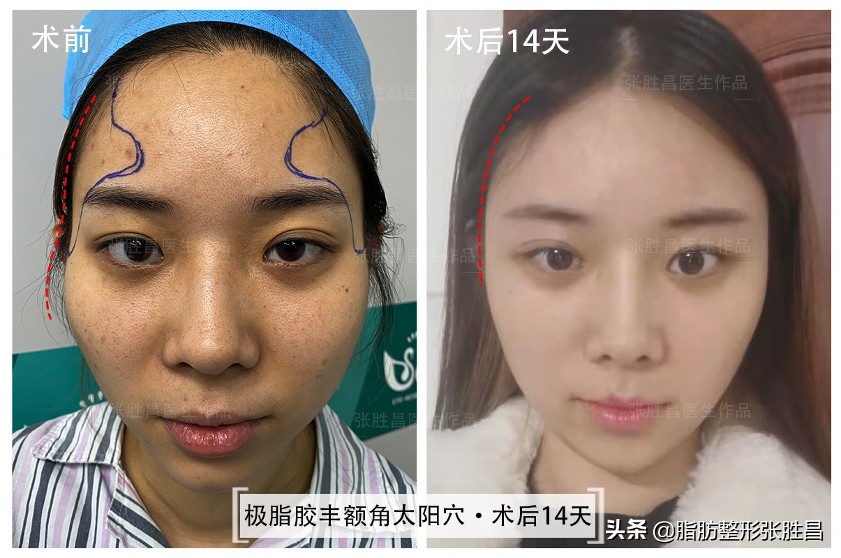 颧骨高只能颧骨内推？她怕开刀磨骨创伤大，仅做脂肪填充就改善了
