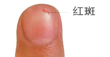 指甲有四种现象很危险,指甲反映身体状况