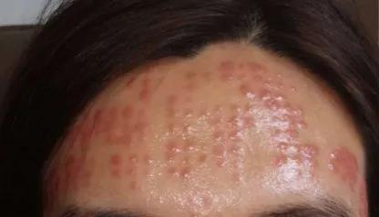 一次水光针需要2000多针吗,一次水光针等于100片面膜