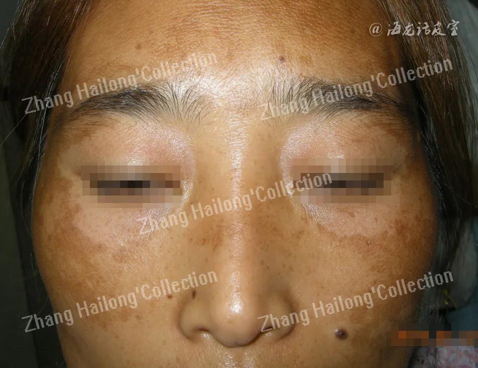 褐斑怎么办,褐斑怎么治才能除根