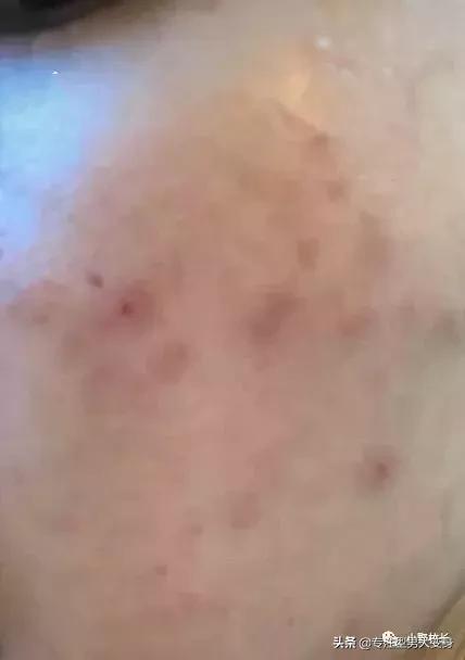 祛痘印有效的精华,祛痘印最有效的方法有4招