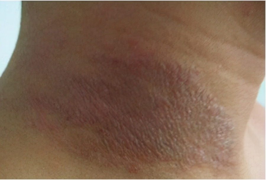 晚上睡不着皮肤瘙痒是什么原因,晚上睡不着身上到处痒怎么办