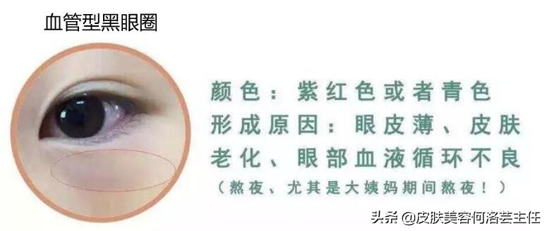 熬夜怎么快速去除黑眼圈,熬夜怎么消除黑眼圈学生党