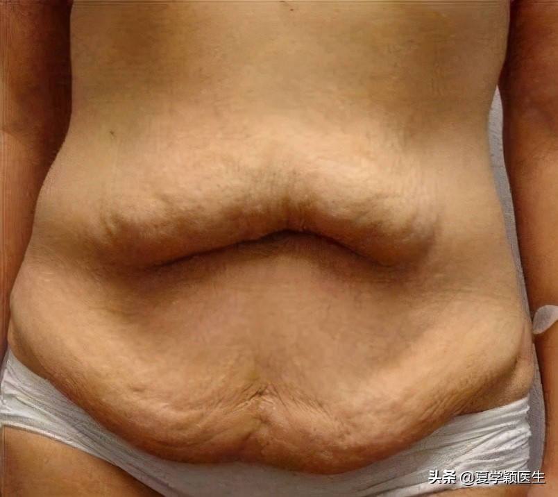 腹壁成形和剖腹产哪个手术更大,产后多久可以做腹壁成形手术