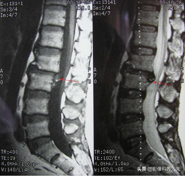 腰椎间盘突出最好的影像诊断方法,腰椎间盘突出的影像学检查