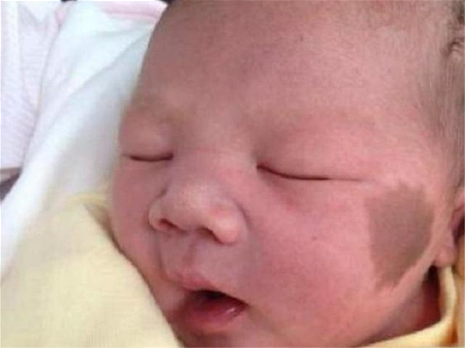 胎儿长胎记是怎么造成的,胎儿容易长胎记的原因是什么