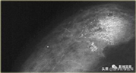 乳腺钙化怎么区分良性和恶性,乳腺钙化的诊断与分级