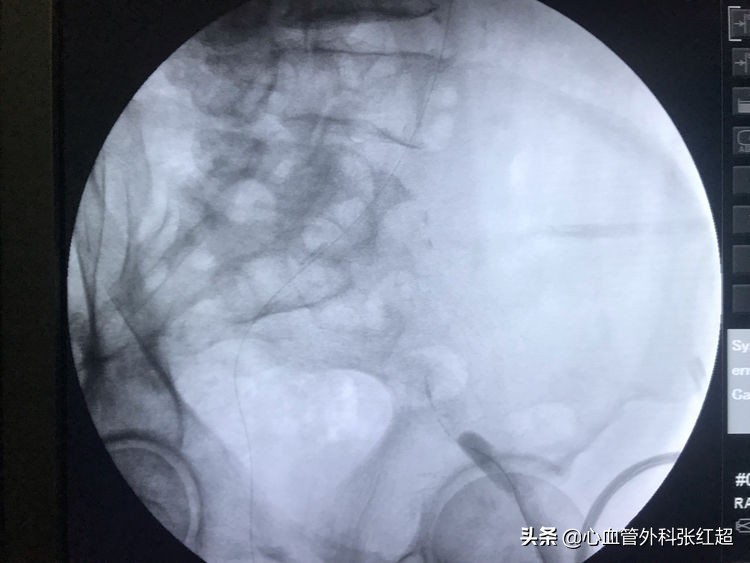 外周血管治疗图,外周血管疾病怎么治