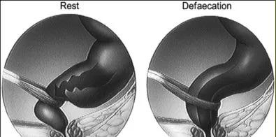检查便秘用做肠镜吗,检查便秘的科室